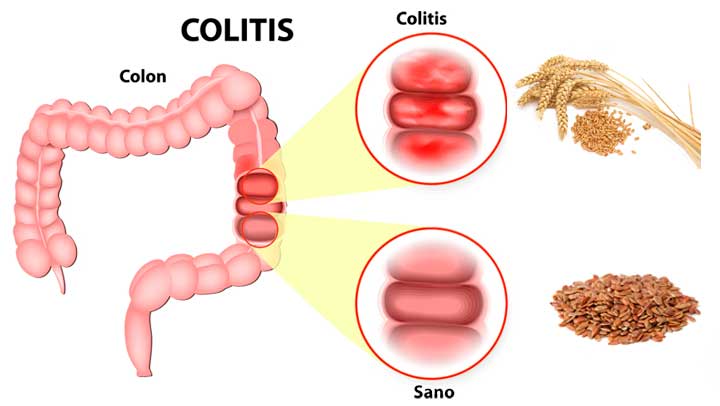 Colite Aguda E Cr Nica Causas Tipos Sintomas Diagn Stico The Best