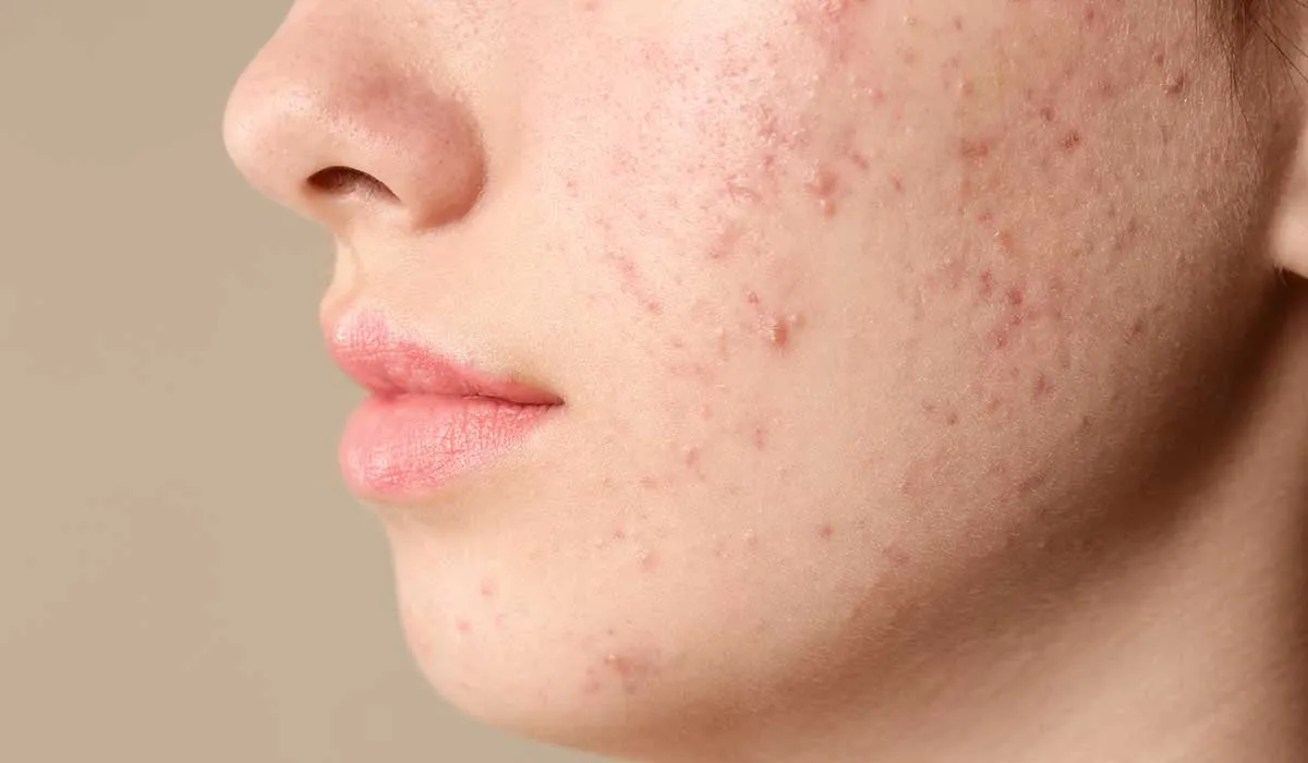 combate el acné con estos remedios