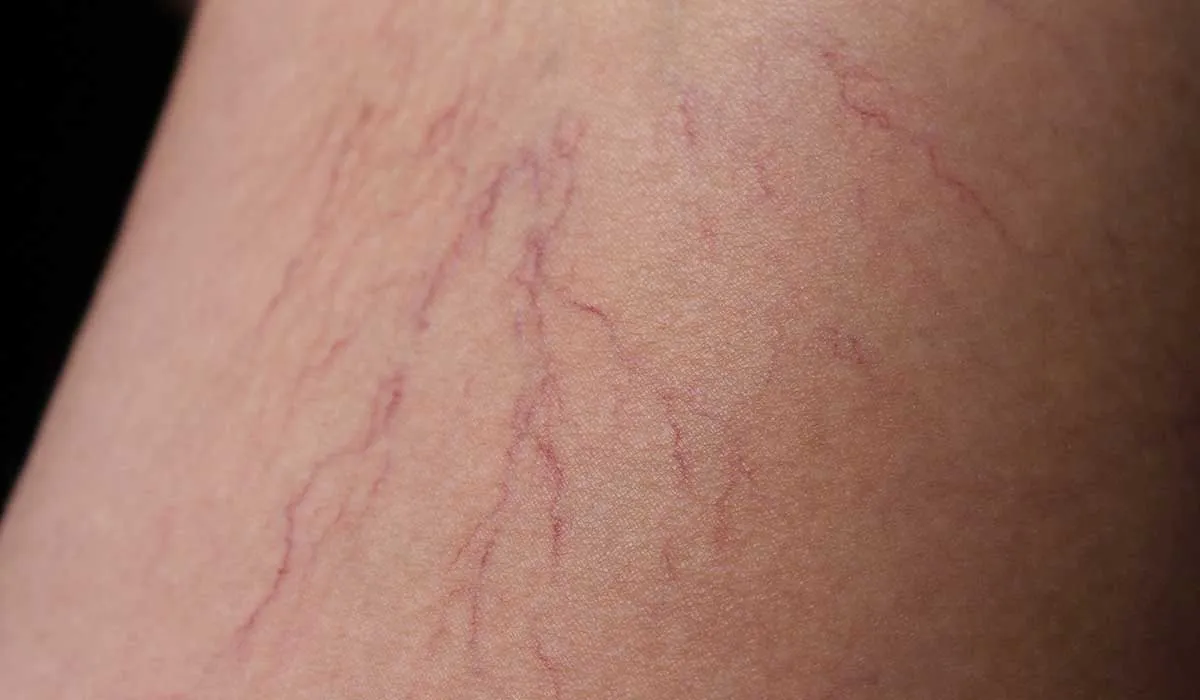 dolor provocado por las várices