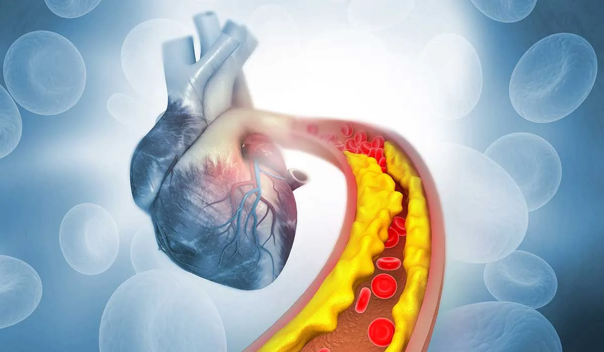cómo afecta el colesterol y la presión a tu corazón