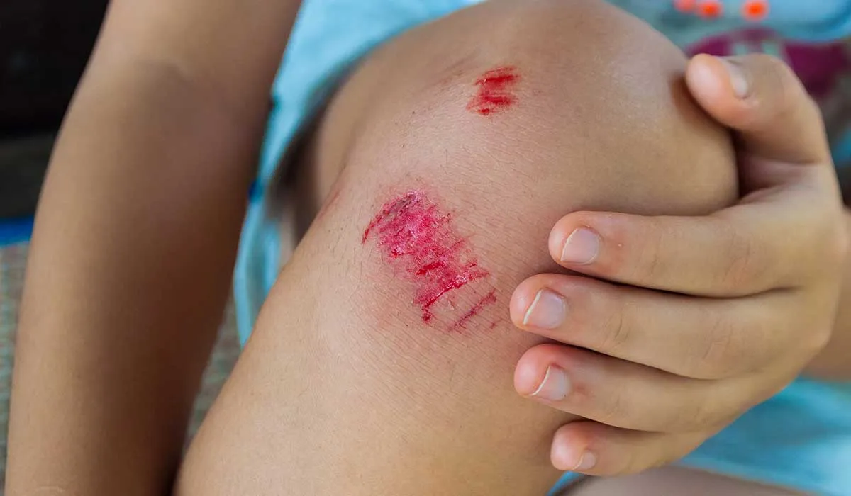 por qué la cicatrización es más rápida en algunas personas