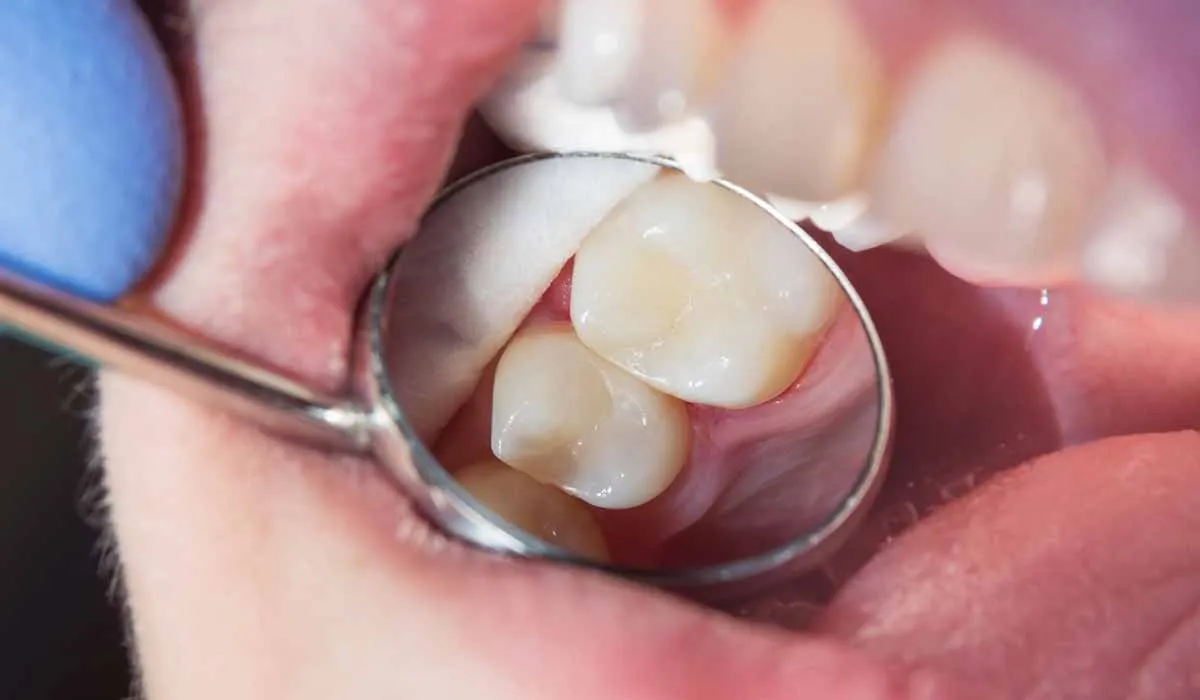 ¿Por qué nos aparecen las caries en los dientes?
