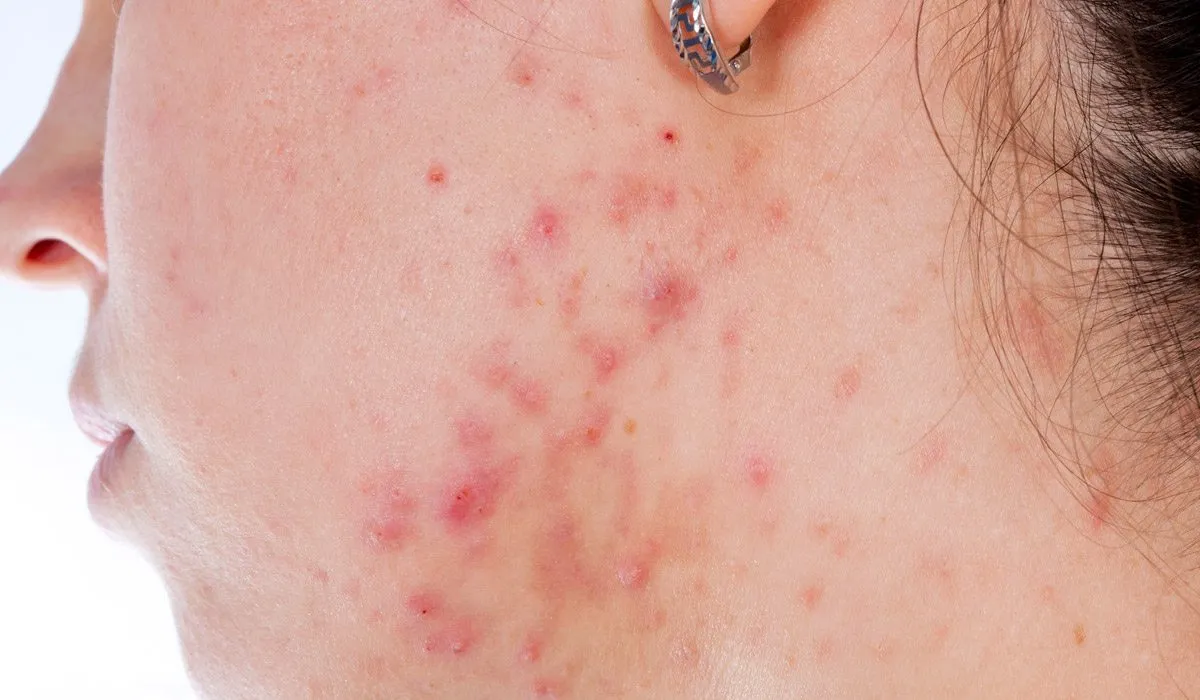 remedios naturales contra el acné