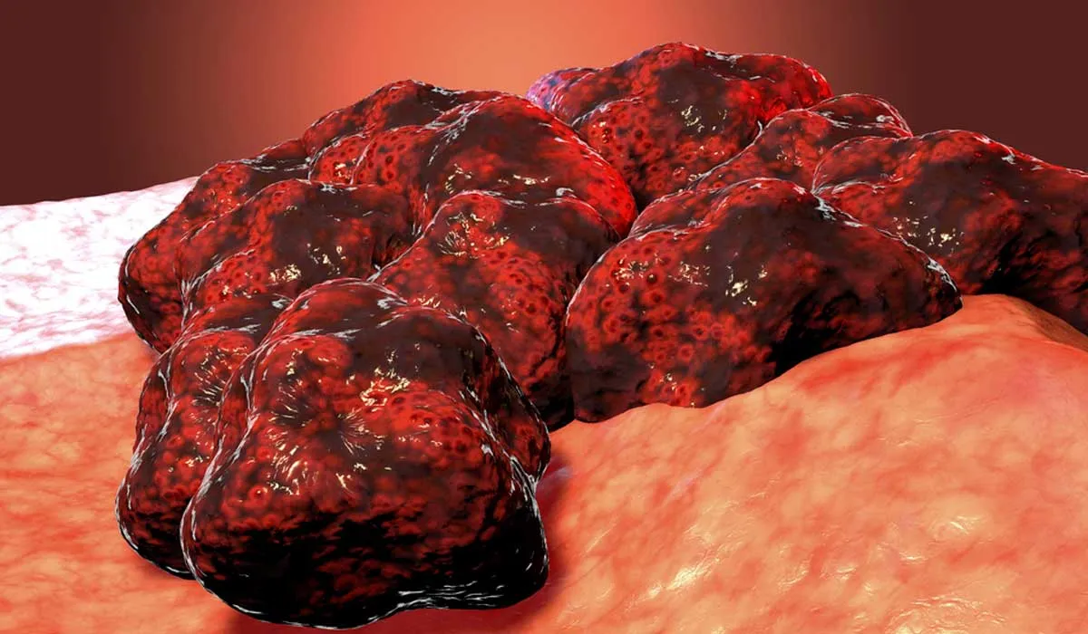 ¿son cancerosos todos los tumores?