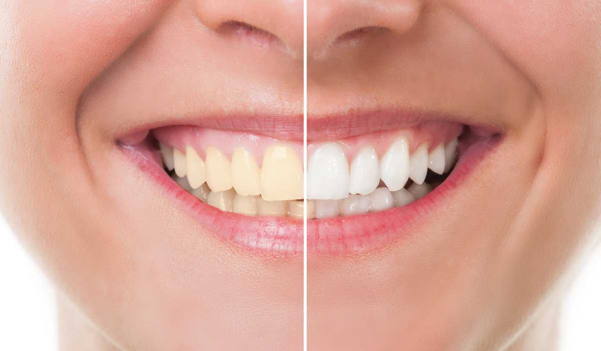 7 trucos para tener los dientes blancos y sanos