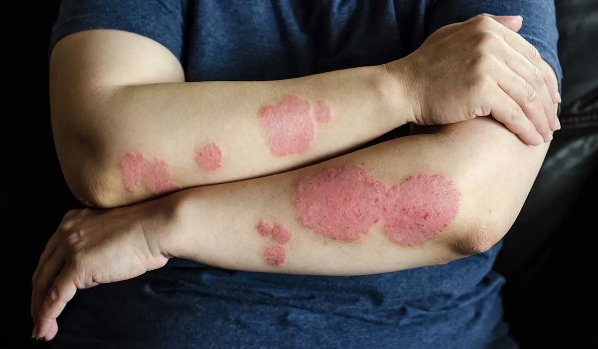 psoriasis cómo atacarla