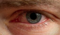 ojos rojos y sus posibles causas
