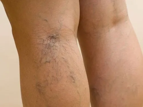 varices