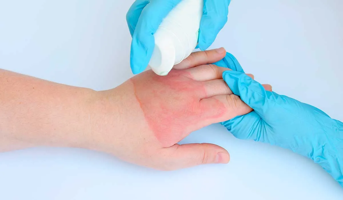 remedios caseros para las quemaduras