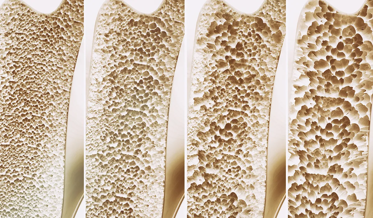¿Osteoporosis en tu familia?