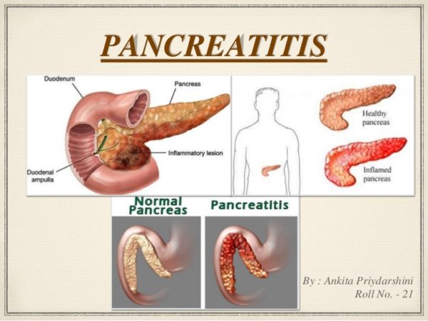 Resultado de imagen para pancreatitis