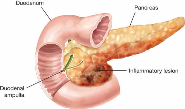 tratamiento-pancreatitis.-sele