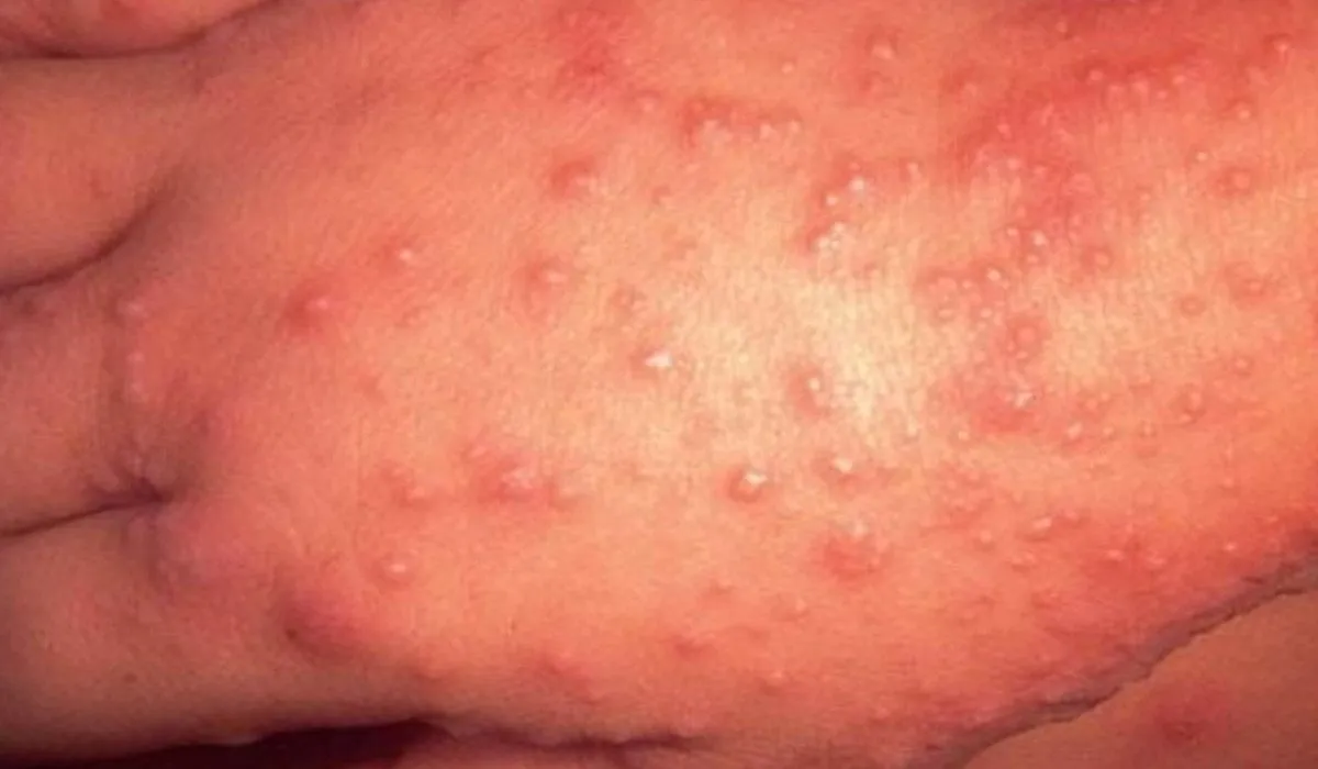 Cierran 12 escuelas por el virus Coxsackie