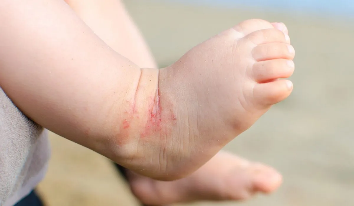 La dermatitis atópica impacta emocionalmente