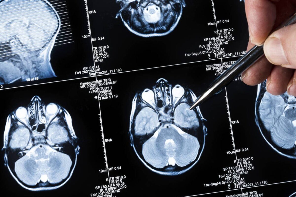 tumor cerebral