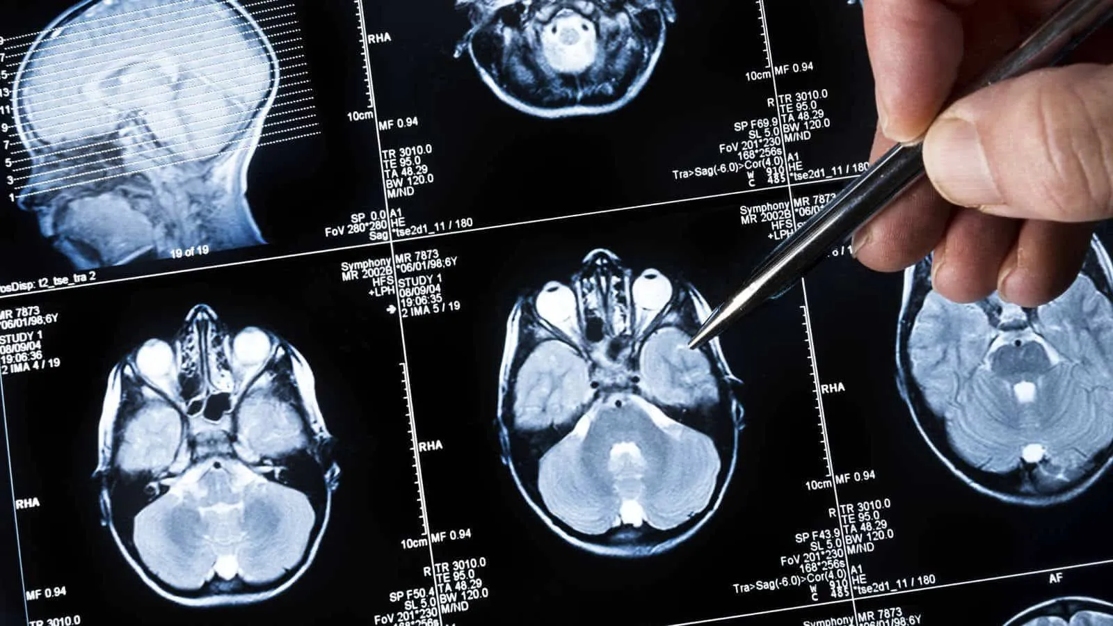 tumor cerebral