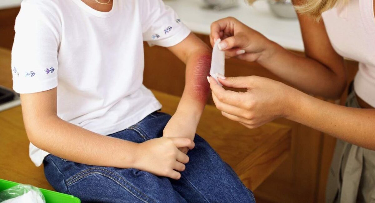 Medidas para prevenir quemaduras de niños en casa