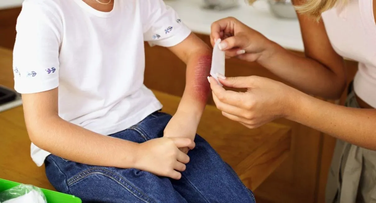 Medidas para prevenir quemaduras de niños en casa