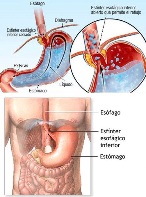 Claves para evitar el reflujo ácido