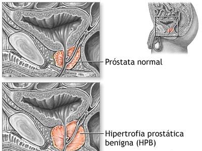 Hiperplasia prostática benigna