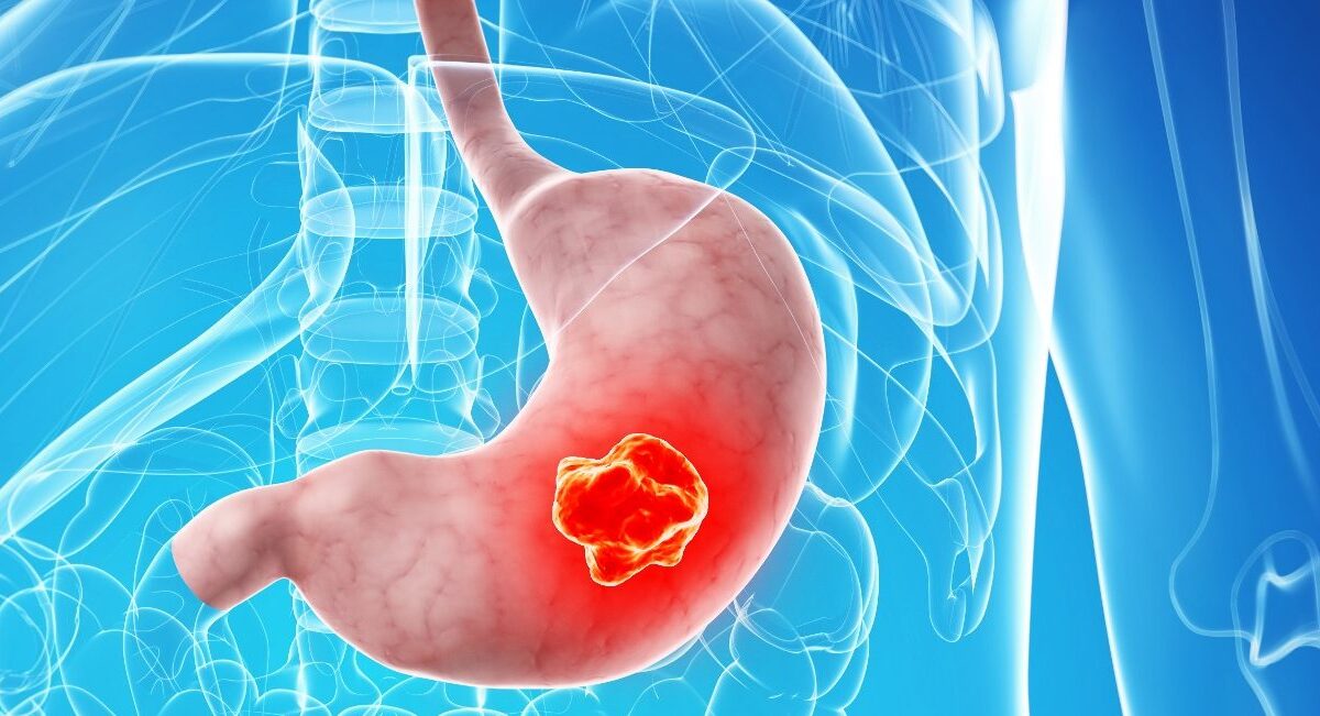 cáncer gástrico