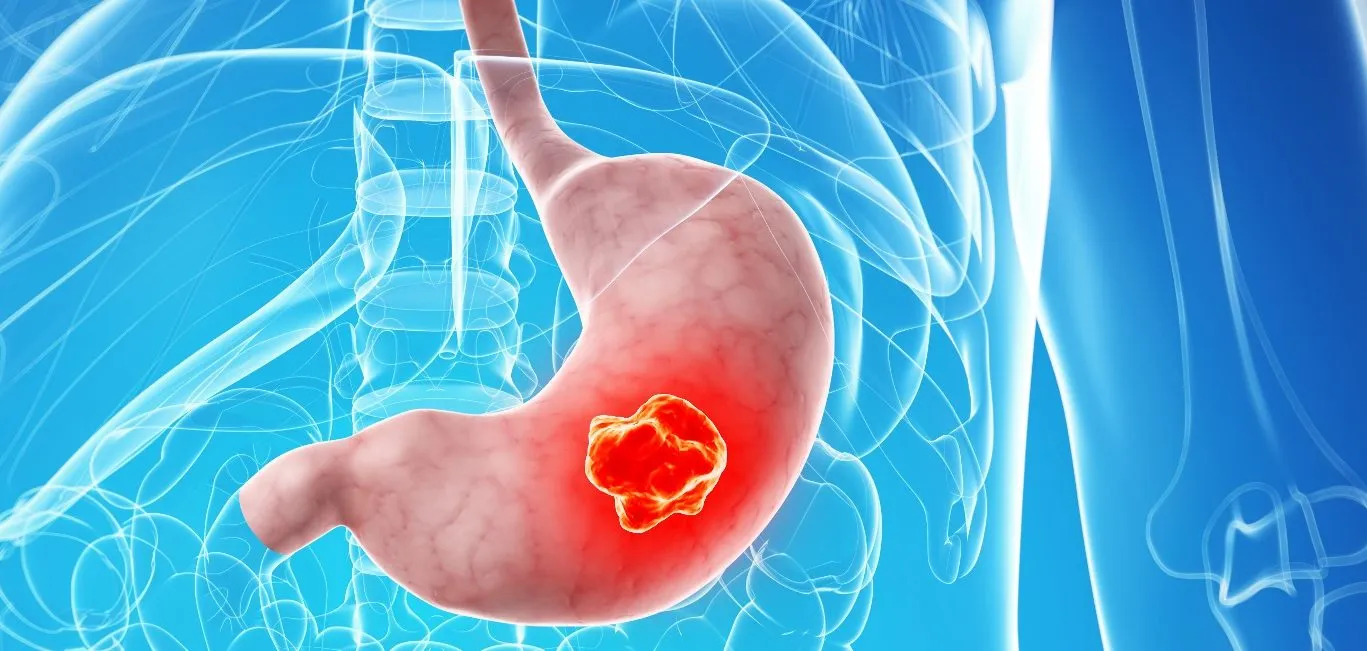 cáncer gástrico