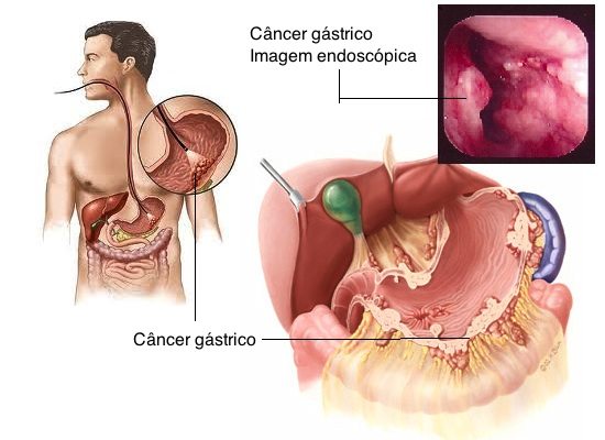 cáncer gástrico