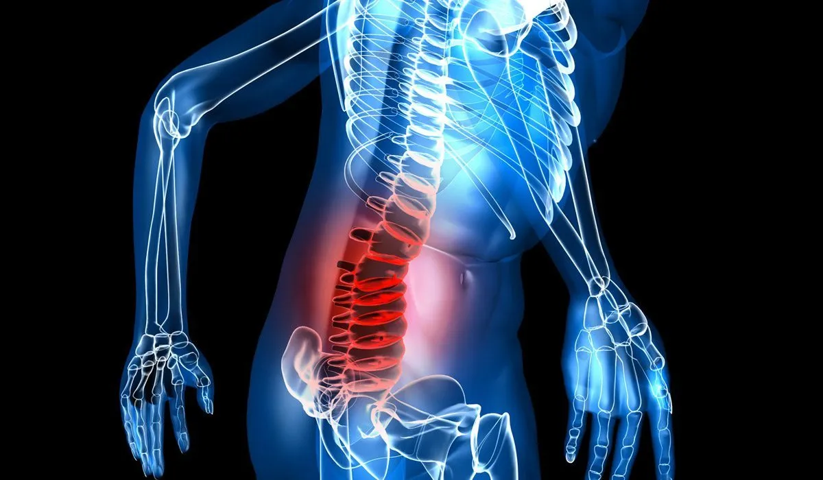 Cómo detectar y tratar un hernia de disco