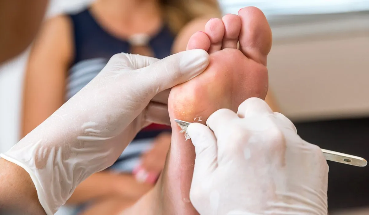 Adiós callosidades con estos remedios