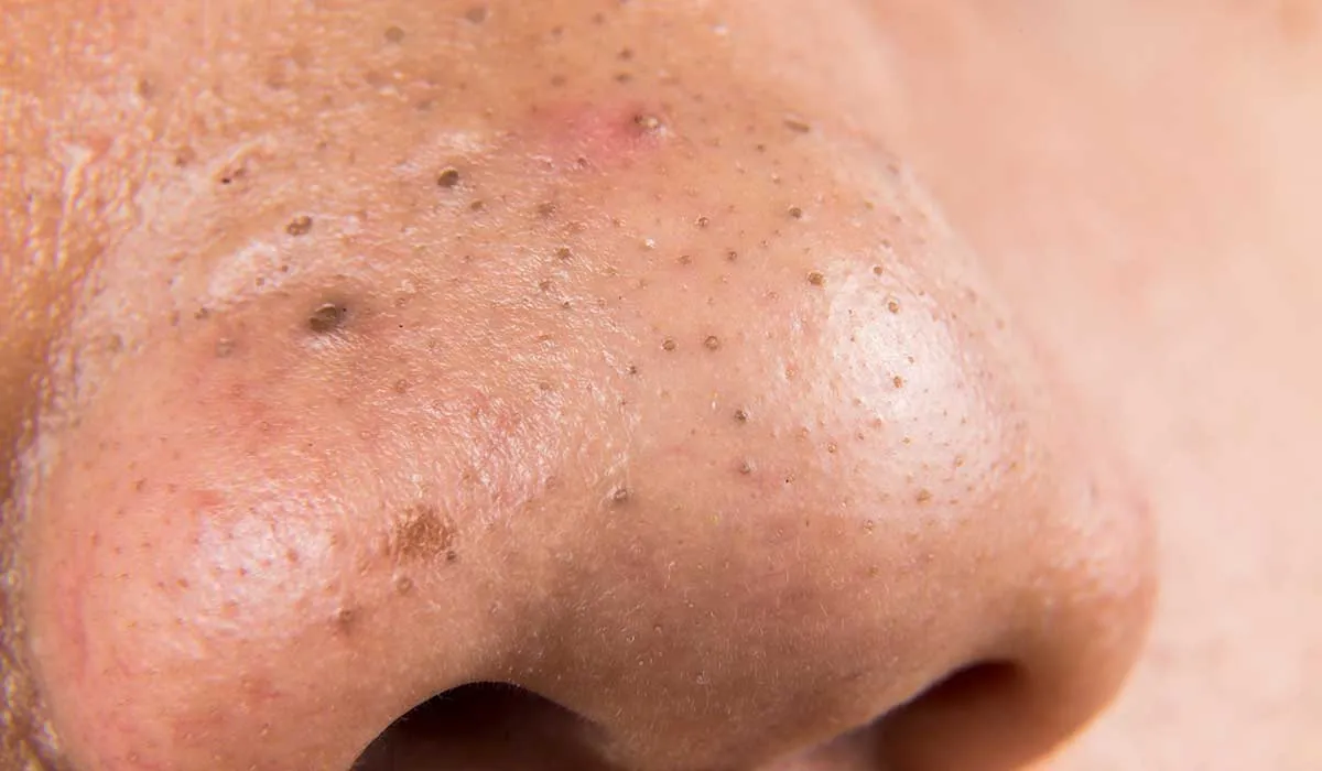 remedios naturales para los puntos negros de la piel