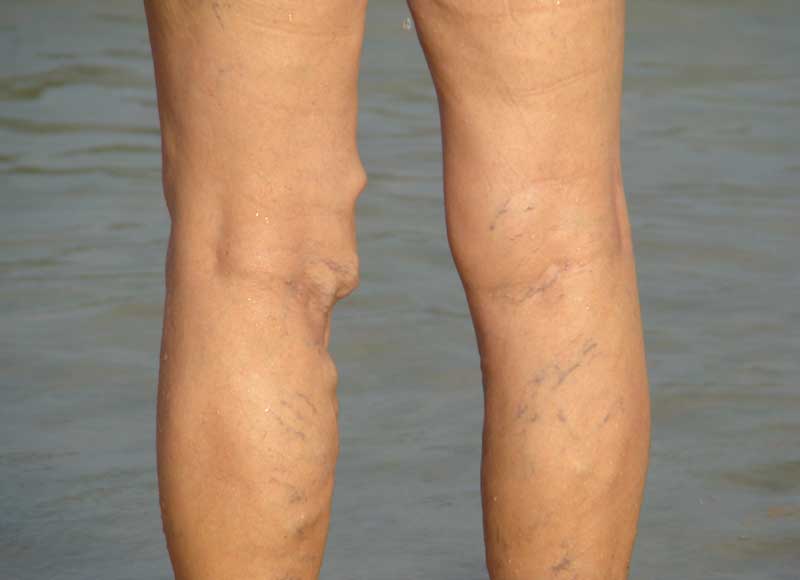 Eliminar forma varices natural las puede se de