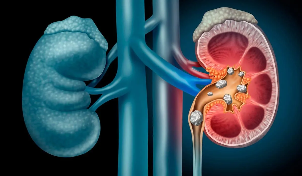 cómo combatir los cálculos renales