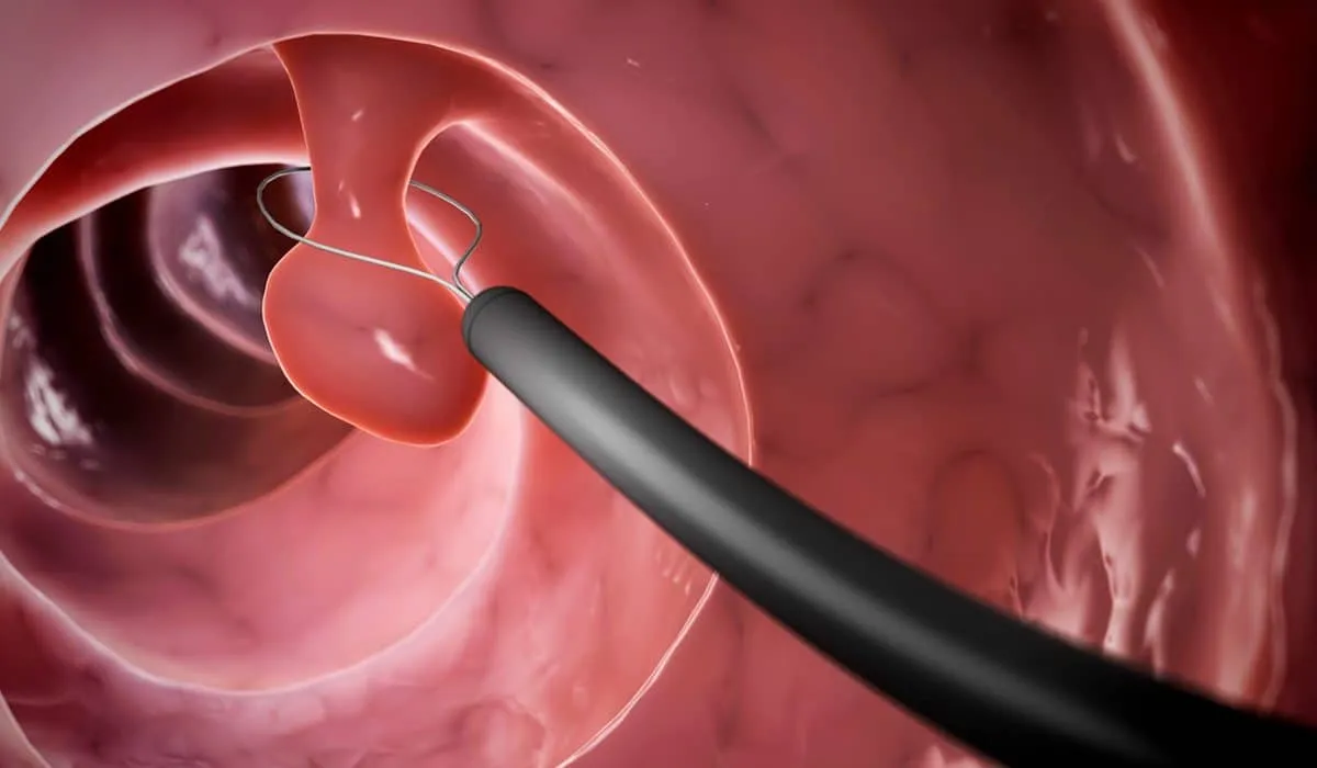 El cáncer colorrectal, la tercera causa más común de cáncer