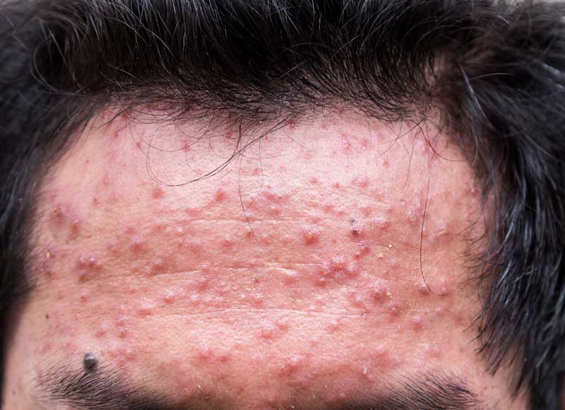 Porque sale acne en los brazos