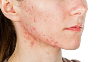 el acné podría esconder enfermedades de nuestro cuerpo