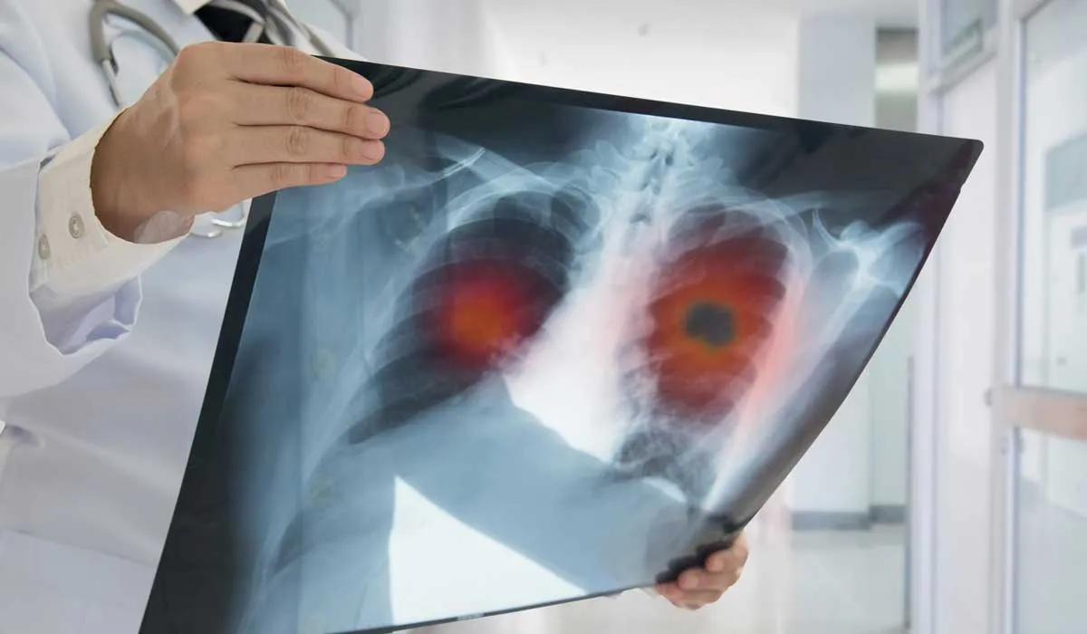 43% de los casos de cáncer de pulmón en México son no fumadores