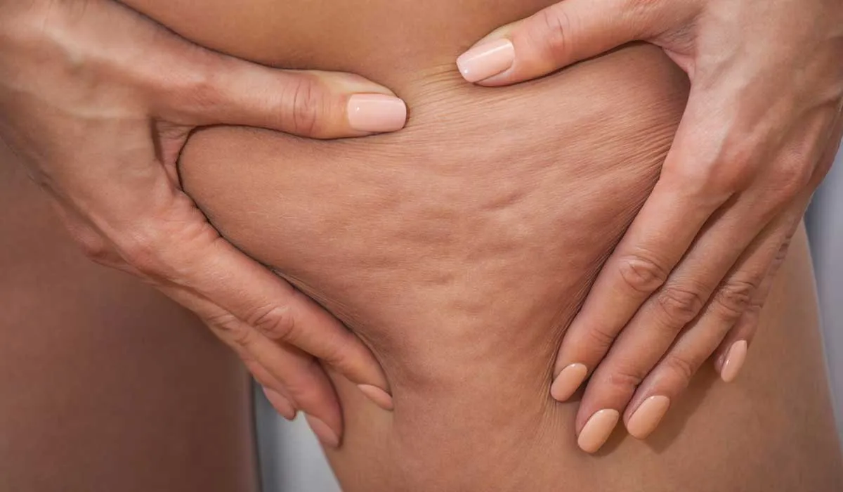 ¿es peligrosa la celulitis?