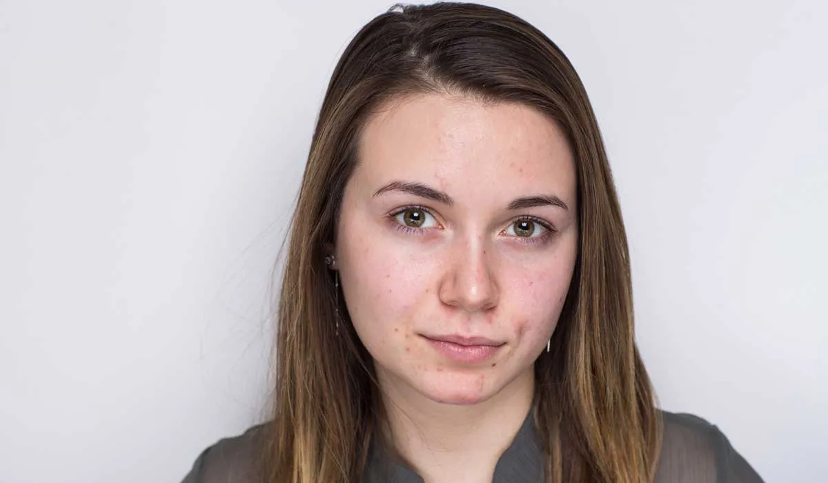 Acné, un problema más allá de la adolescencia