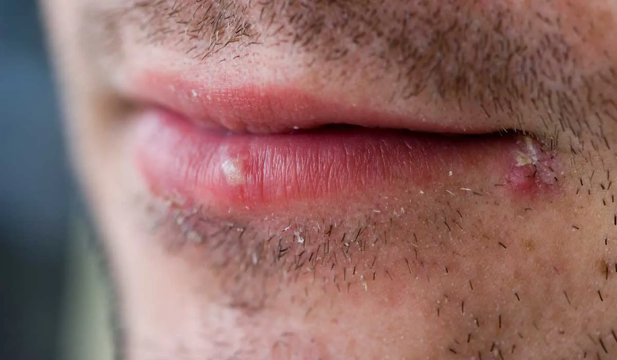 gana la batalla al herpes