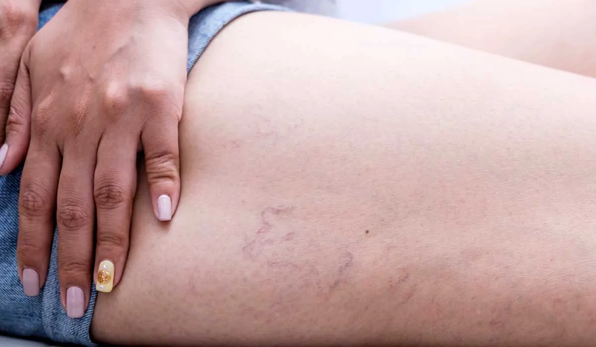 accidente cerebrovascular en mujeres