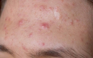 cómo evitar el acné