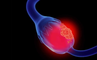 en México mueren muchas mujeres por cáncer de ovario