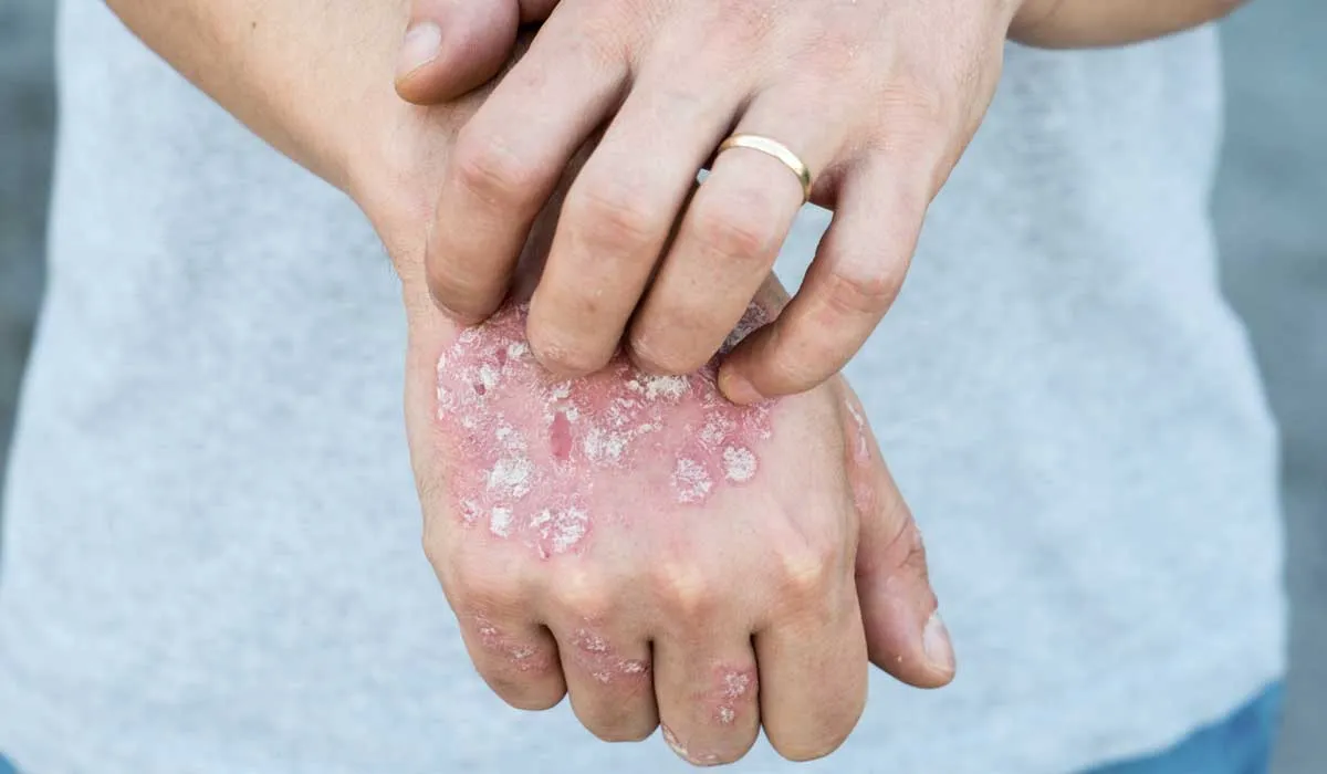 Al menos 2.5 millones de mexicanos padecen psoriasis