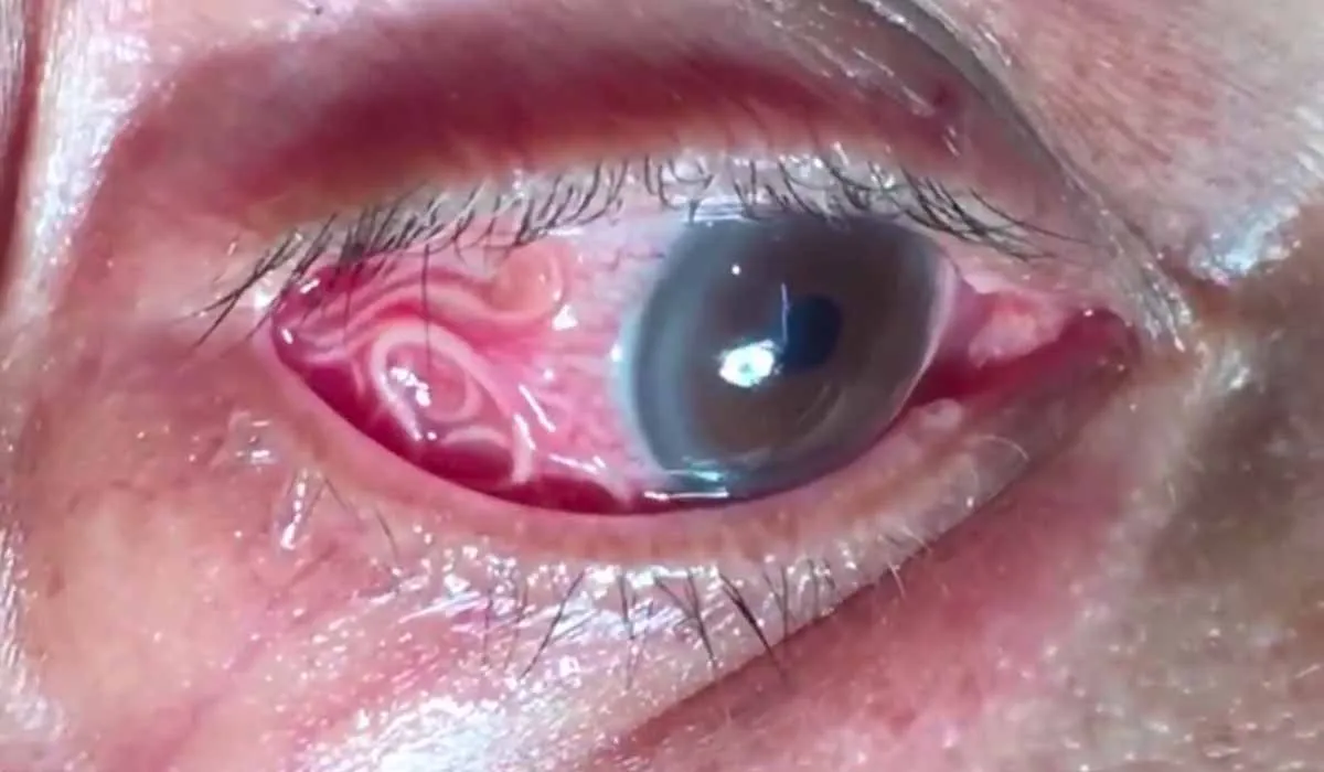 Increíble momento cuando le quitaron un gusano de 15 cm de su ojo