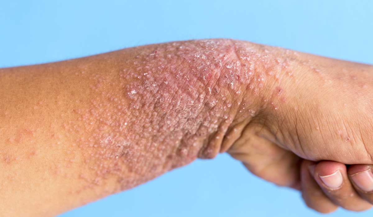 qué es la dermatitis atópica