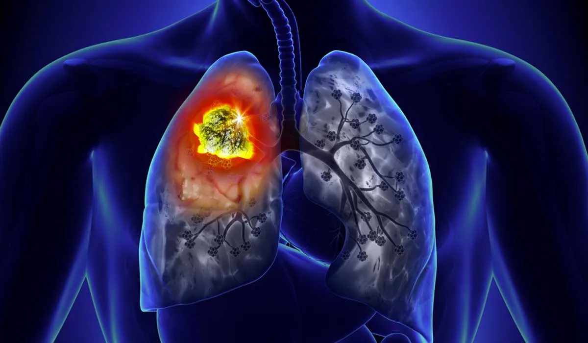 Más vida para pacientes con cáncer de pulmón
