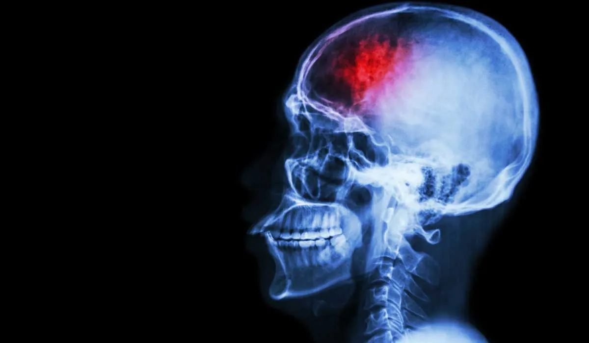 síntomas de un derrame cerebral