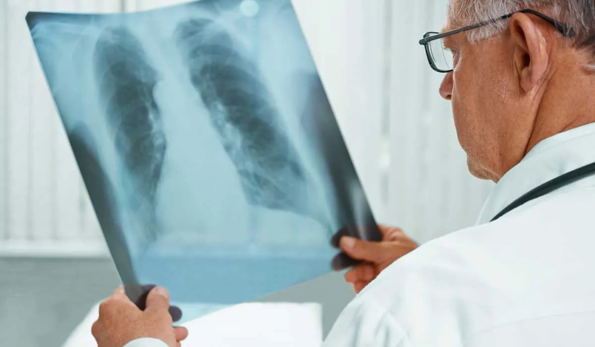 Aumenta el número de casos de mujeres sin fumar con cáncer de pulmón