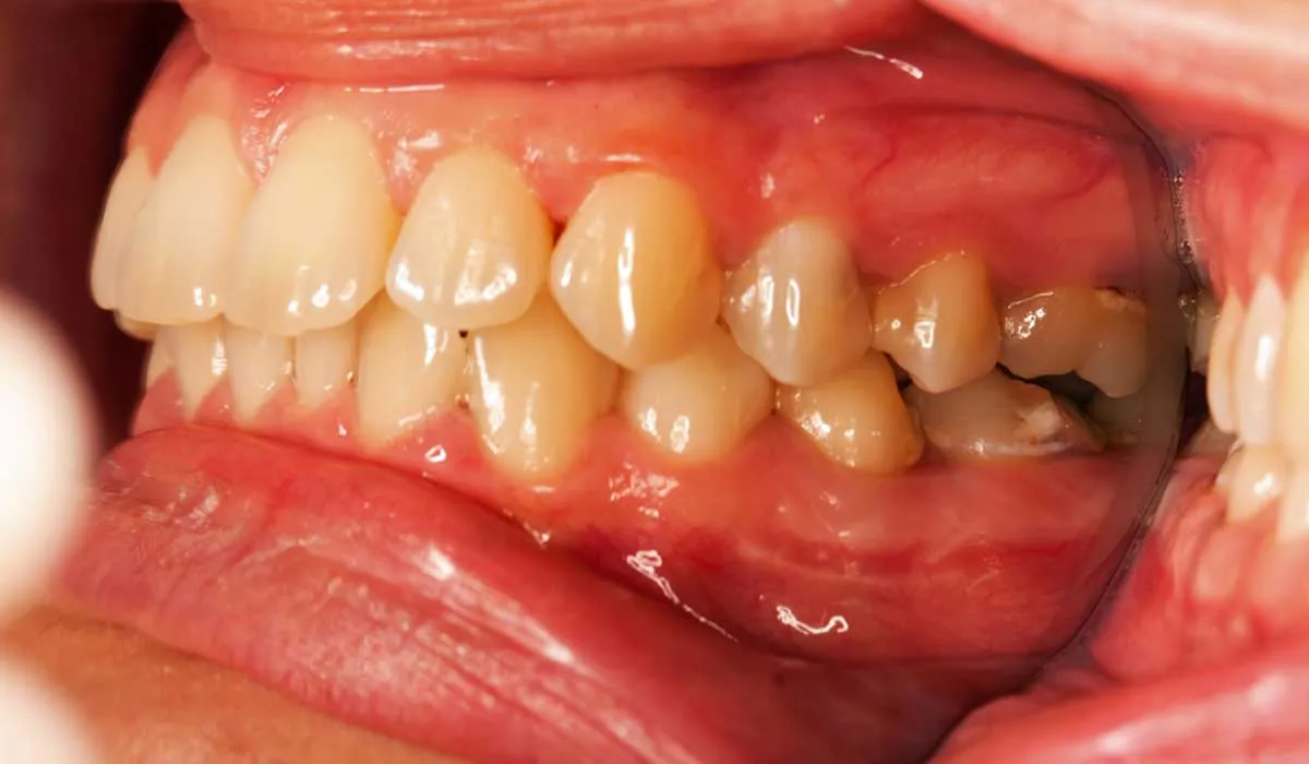 por esto te pueden sangrar las encías