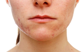 remedios naturales contra el acné